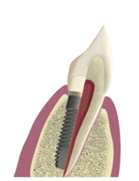 Neoss Implantat